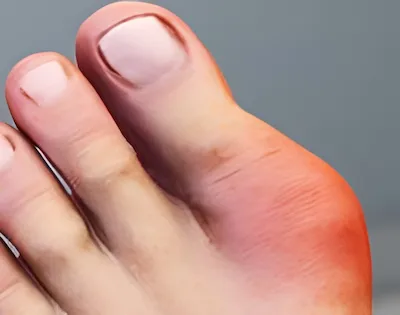 foot gout